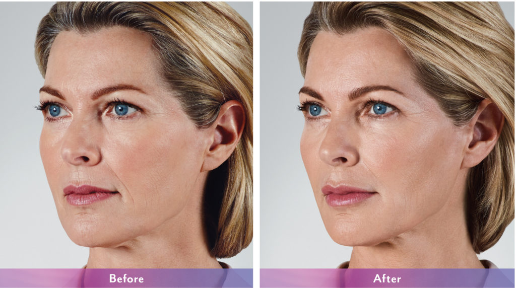 Juvéderm® San Antonio & Boerne Dermatologist