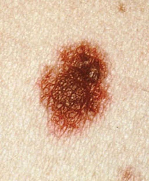 Identification des types de grains de beauté Dermatologie DeSilva Maria Kani