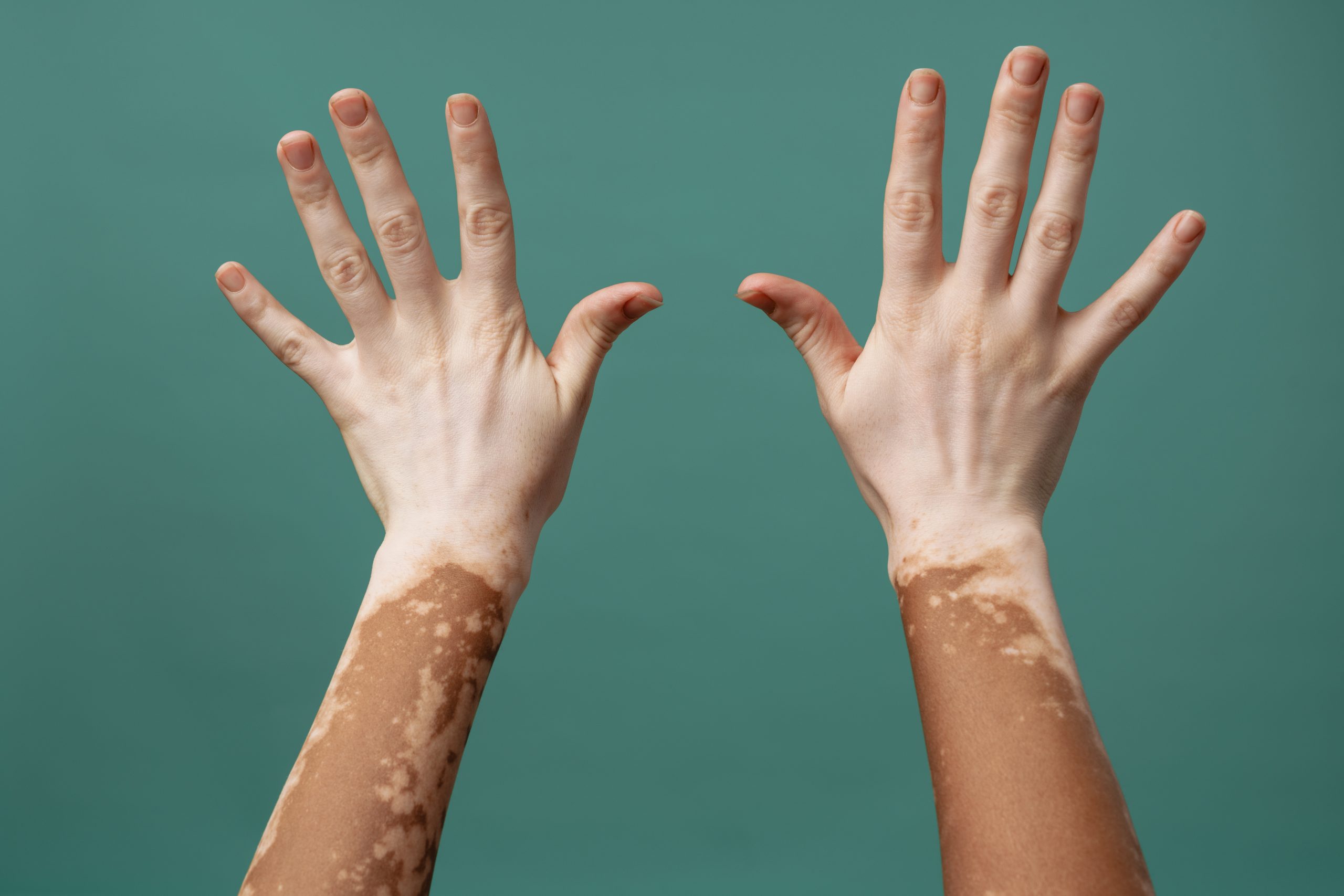 Understanding Hyperhidrosis