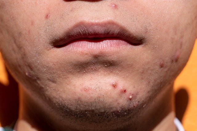 3 Guilt Free acne Tips