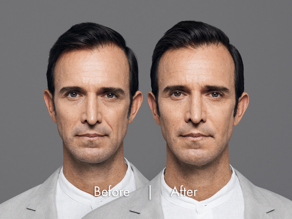 RHA® Collection of Fillers San Antonio & Boerne Dermatologist