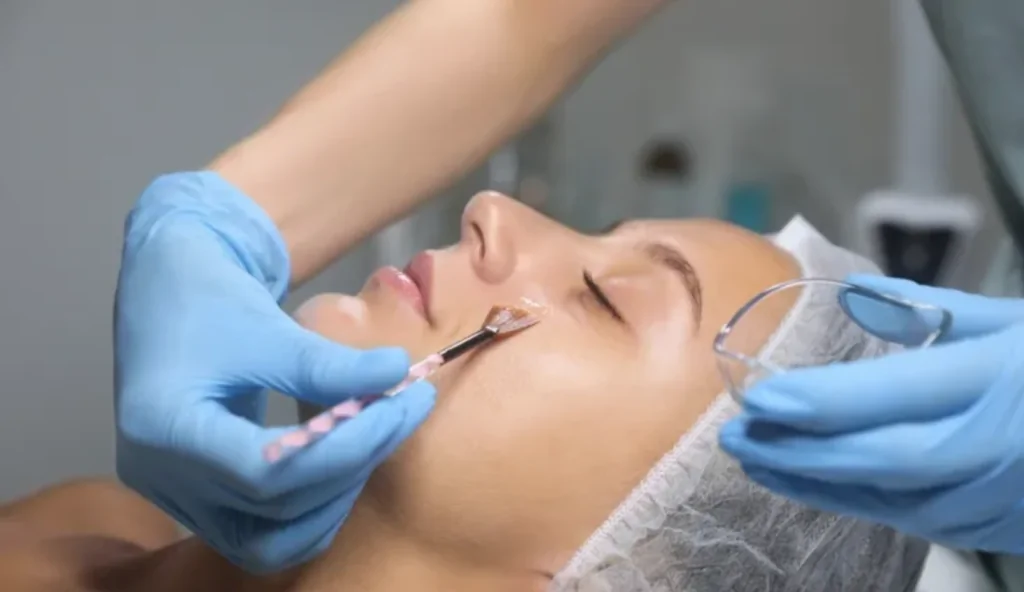 All About PCA Skin Peels