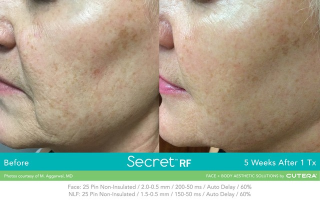Secret RF Microneedling - Boerne Dermatologist