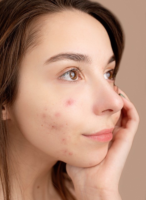 Summer Acne: Why Heat, Sweat, Sunscreen, and Sports Can Trigger Breakouts